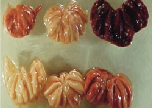 Bệnh Gumboro